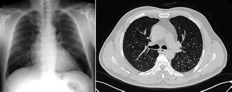 A Posteroanterior Chest Radiography Demonstrating Diffuse Millimetric