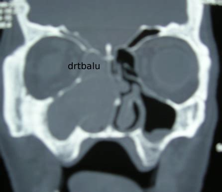 Nasal Polyps Ct