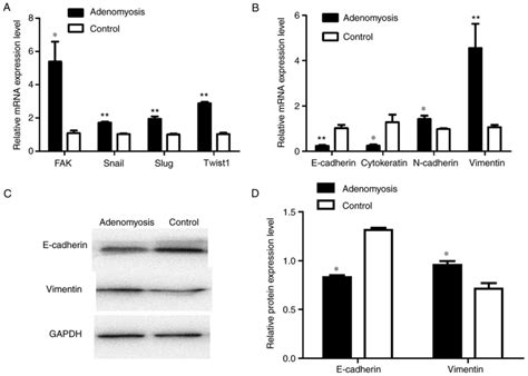 Fak Regulates Epithelialmesenchymal Transition In Adenomyosis