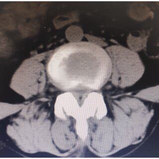 Preoperative Axial Computed Tomography Ct Image Of L L Showing