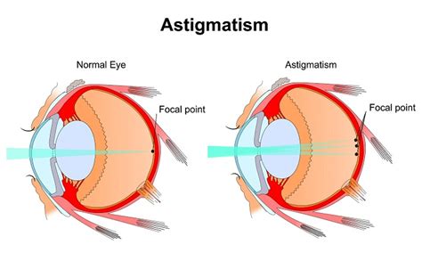 Astigmatism Causes Symptoms Treatment Of Astigmatism