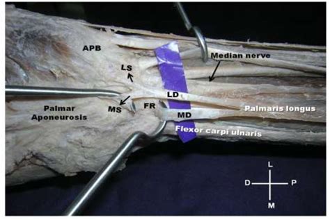 Figure 1 From Presence Of Multiple Tendinous Insertions Of Palmaris