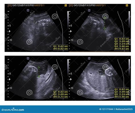 Ultrasound Abdomen.Ultrasound Scan Medical Imaging Of Abdomen ...