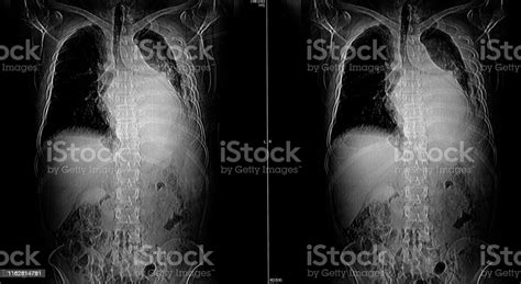 Computer Tomography Angiography Cta Of Whole Body Scan With 3d Reconstruction Ct Angiography For