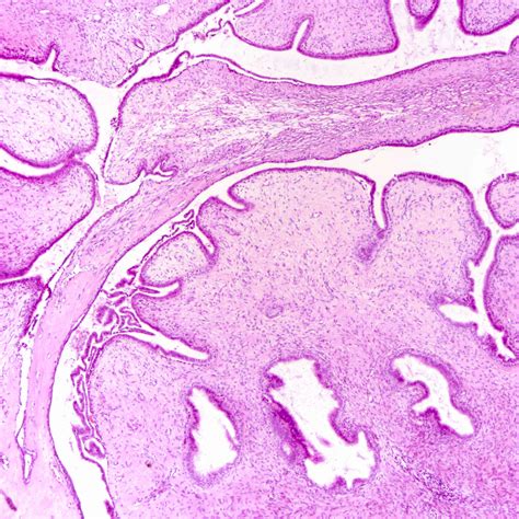 Phyllodes Tumor Growth Rate