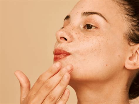 How To Treat Acne Around The Mouth According To Dermatologists