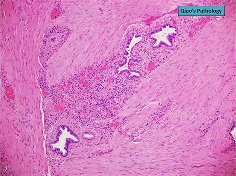 Qiao S Pathology Adenomyomatosis Adenomyomatous Hyperplasia Of The