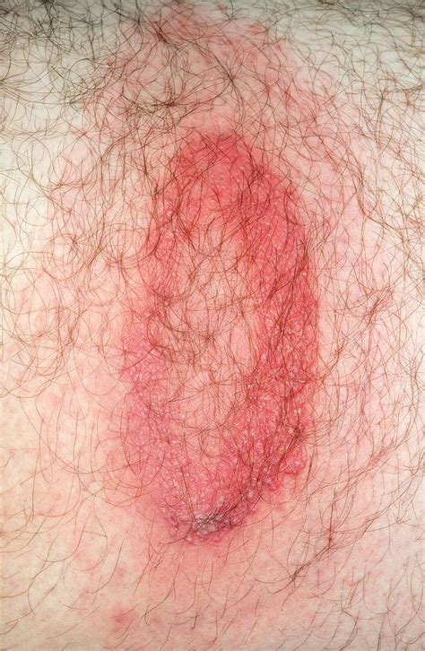 Erythema Migrans Rash In Lyme Disease Photograph By Dr P Marazzi