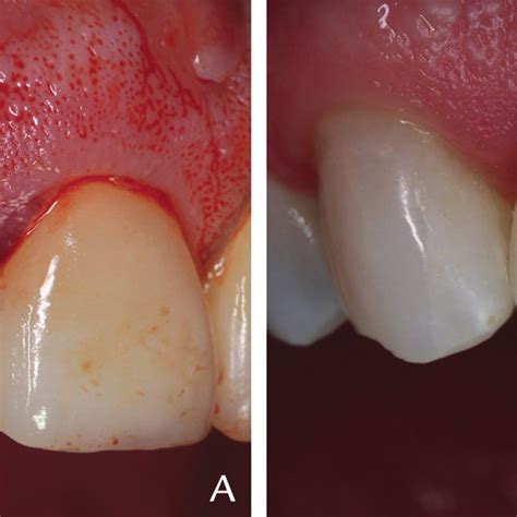 A Extruded Incisor B Restored Tooth 1 Year After Surgical Extrusion Download Scientific