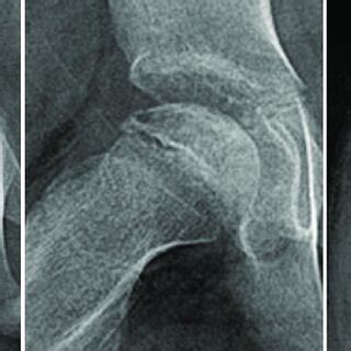 Anteroposterior A And Frog Leg Lateral B Radiographs Of The Hip Of