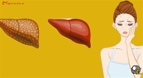 Pay Attention 6 Warning Signs That Tell You That Your Liver Is Full