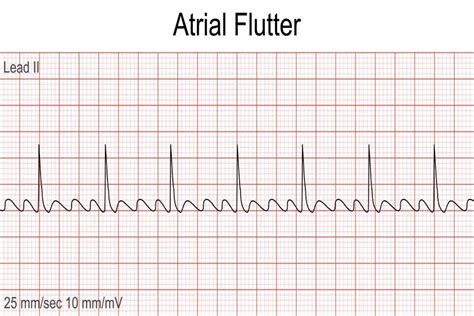 Atrial Flutter An In Depth Exploration Of A Heart Rhythm Disorder