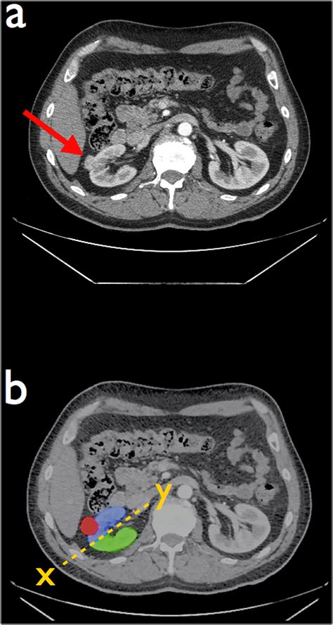 Axial Ct Scan Demonstrating A Small Tumour On The Anterior Aspect Of