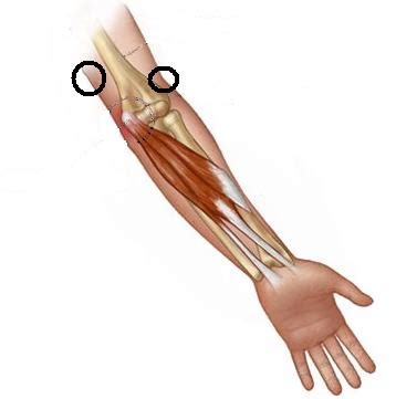 Help identifying inner elbow pain, can't straighten arm