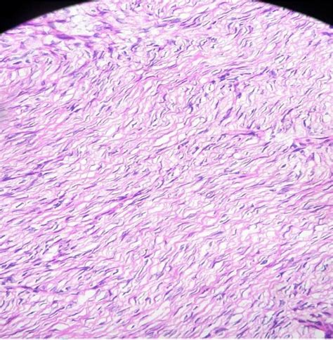 The Histological Findings Showed Storiform Spindle Cells Proliferation