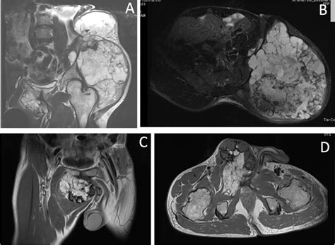 A And B Mr Images Showed A Tumor On The Left Iliac Wing C And D Mr Download Scientific