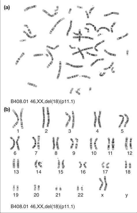 G Banded Chromosomes From A Female With An 18p Deletion And The Xx Sex Download Scientific