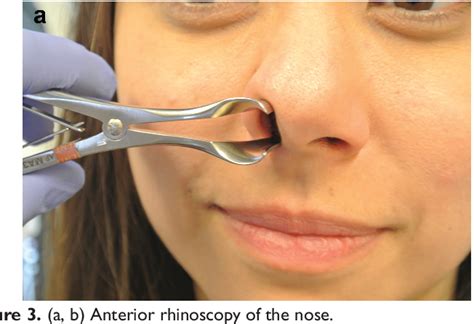 Figure 1 From Clinical Practice Guideline Nosebleed Epistaxis Semantic Scholar