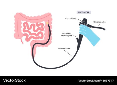 Colonoscopy medical procedure Royalty Free Vector Image