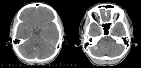 Contrast Enhanced Brain Ct Showing Solid And Enhanced Nodules In The