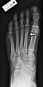 Metatarsal Bone Fracture