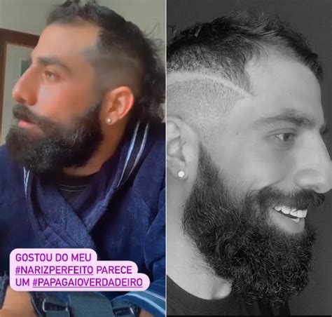 Kaysar Dadour mostra o nariz após cirurgia e nega plástica Continua