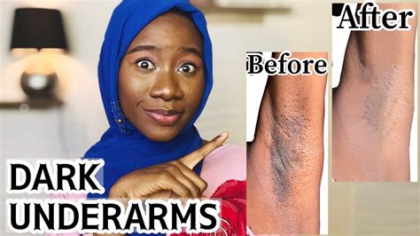 Dark Underarms Causes Tips And Solutions Get Rid Of Dark Armpits