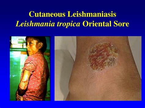 Ppt Cutaneous Leishmaniasis Leishmania Tropica Oriental Sore