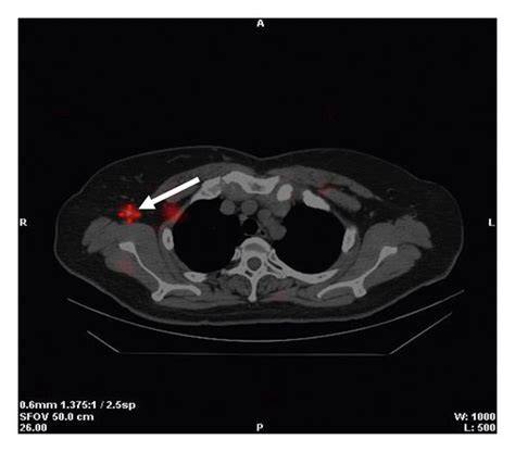 A 60 Year Old Female Patient With Invasive Ductal Carcinoma Of The