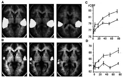 A Regions Of Significantly Increased Regional Cerebral Blood Flow