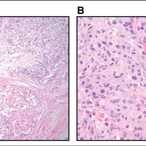 Hematoxylin And Eosin He Stains Of The Tumor Specimens For Patient 2