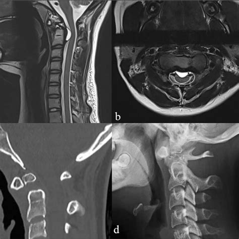 Preoperative imaging studies showing os odontoideum and associated ...