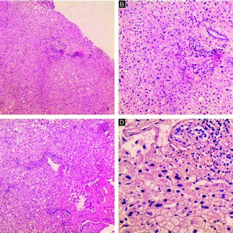 H E Stain A D Microscopic Images Of The Nodule A Well Defined