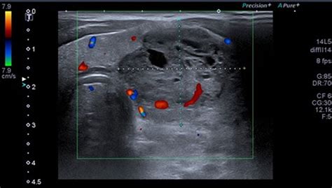 Malignant Teratoma Of The Thyroid Bmj Case Reports