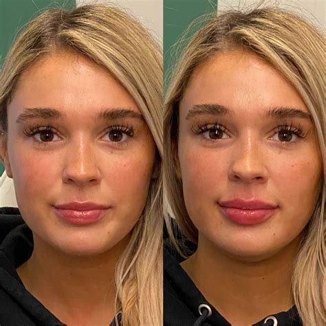 Dermal Fillers Lips Before And After