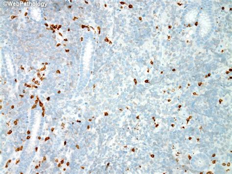 DLBCL Stomach CD3