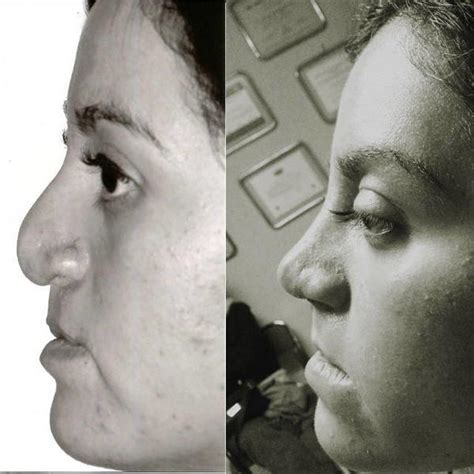 Aquiline Nose Pictures (4) » Rhinoplasty: Cost, Pics, Reviews, Q&A