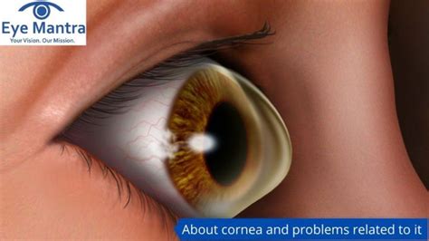 Problems Related To Cornea- Risk, Prevention And Treatment