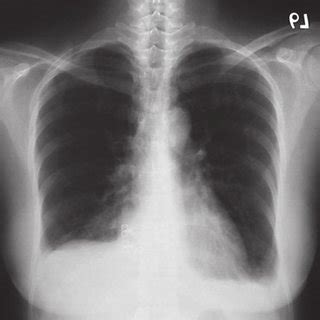 Posterior Anterior Chest Radiograph Taken Days After The Initial