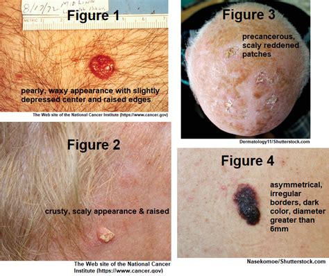 Skin Cancer Types Squamous Cell Carcinoma