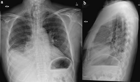 Pulmonary Artery Pseudoaneurysms In The Setting Of Gout Polyarthropathy