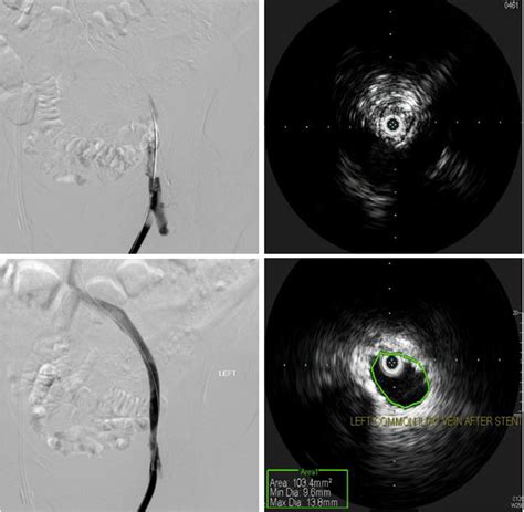 (A) Angiography of lower extremity AV graft showing occlusion of the ...