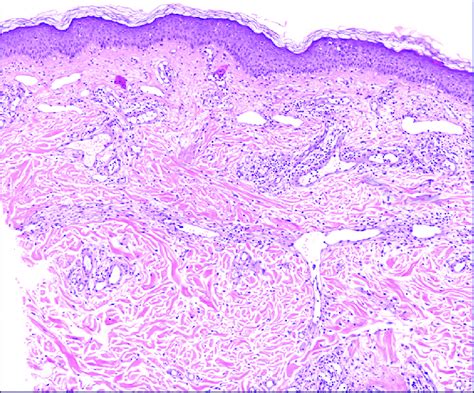 a: Histopathology: Spongiotic dermatitis and telangiectatic vascular... | Download Scientific ...