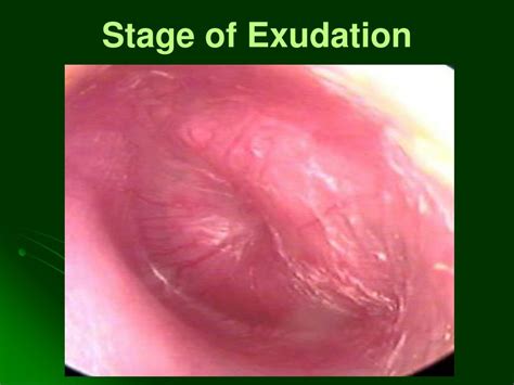 Acute Otitis Media Stages