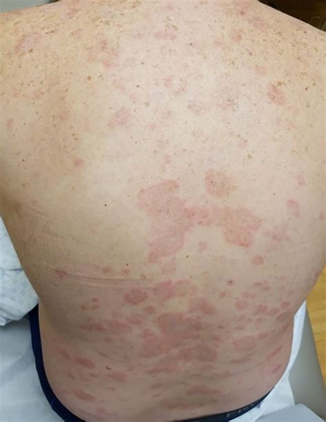 Subacute Cutaneous Lupus