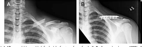 Figure 2 From Shoulder Injuries In Pediatric Athletes Semantic Scholar