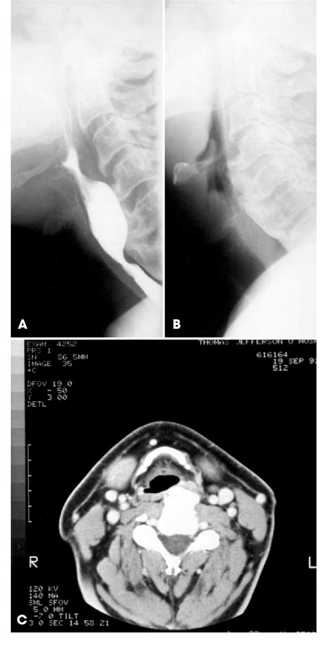 Figure 1 From Dysphagia Caused By Cervical Osteophytes Semantic Scholar