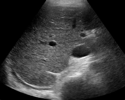 Division Cirrhosis liver findings imaging liveratlas - anacollege