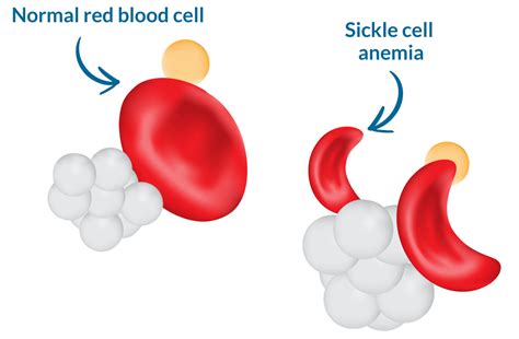 What Is Sickle Cell Anemia Bilarasa