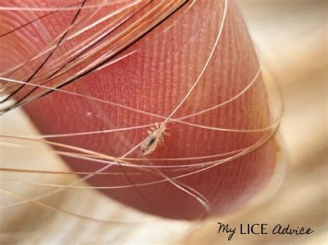 What Lice Look Like: Pictures of Lice (Color, Size, and More)